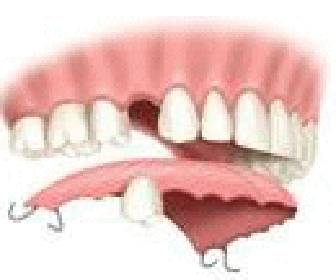 インプラント治療｜野田市 春日部市周辺の歯医者なら、関宿グリーン歯科（歯科・矯正・小児・インビザライン）